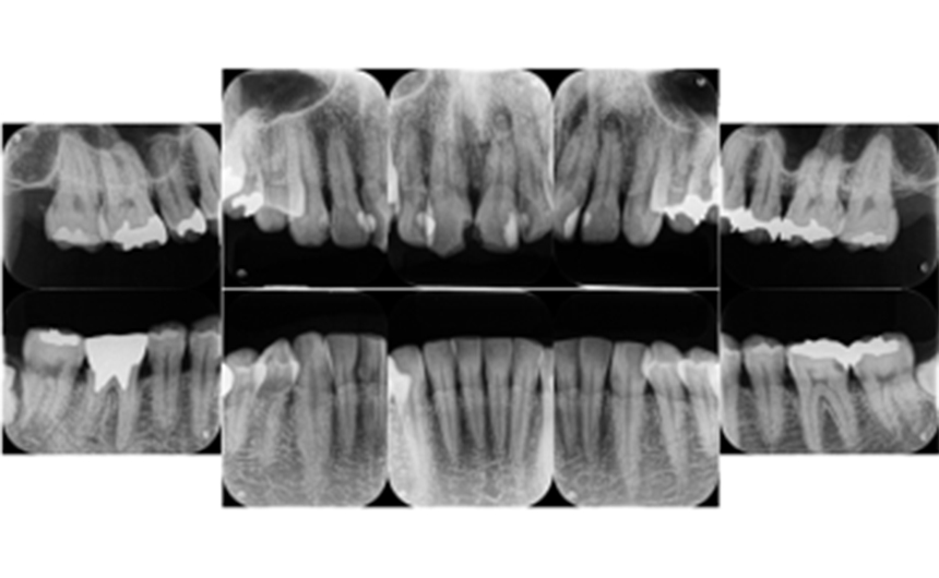 マイクロスコープ（歯科用顕微鏡）とレントゲンで、隠れた歯石を見逃さない