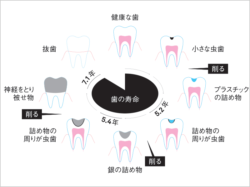 治療回数には限界がある？　知っておきたい「負のデンタルサイクル」