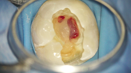 ③ 虫歯除去後、歯髄を確認