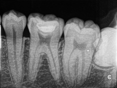 歯髄保存療法　症例1　歯髄まで達する深いむし歯の治療