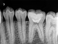 歯髄保存療法　症例　歯髄まで達する深いむし歯の治療