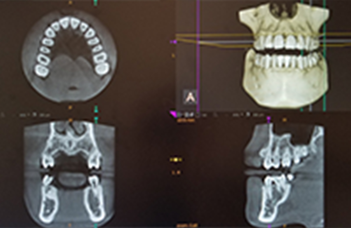 歯科用CT