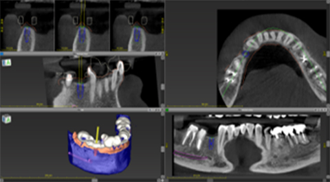 口腔内スキャンと3Dシミュレーション、ガイドを使用する安全・安心な治療
