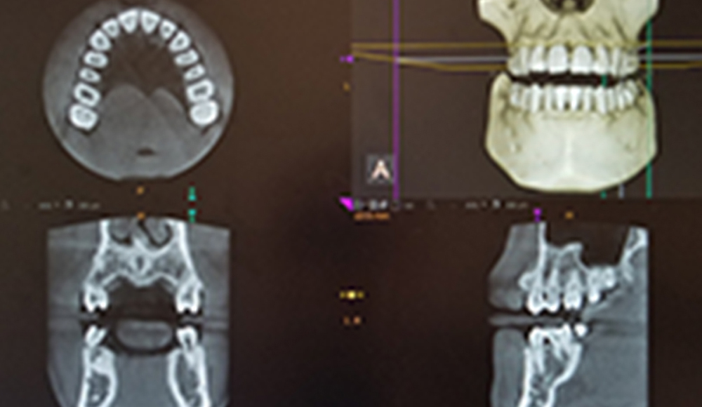 歯科用CTスキャン （Computed Tomography）