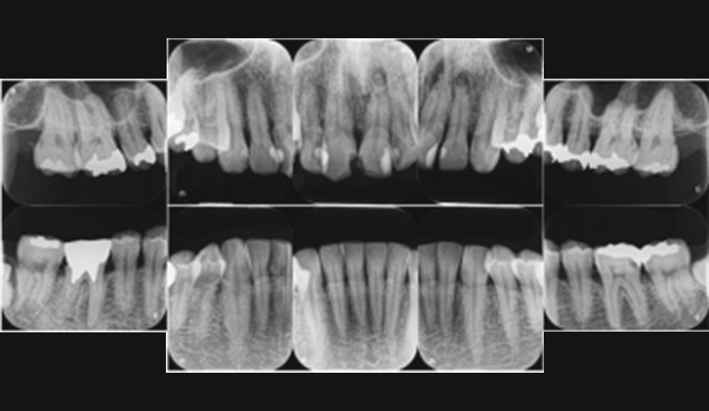 パノラマレントゲン・デンタル14枚