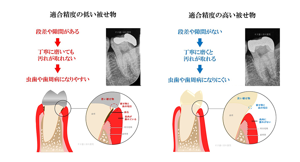 “わずか”な隙間がある、ただそれだけで「再治療のリスク」が高まる