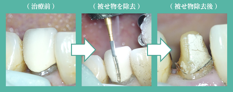 被せ物を外す（1日目）