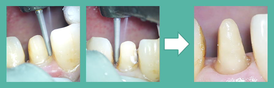 歯の形態を修正（2～3日目）