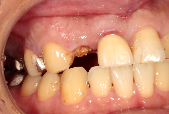 被せる歯質が少ない時には、クラウンレングスニング（歯冠長延長術）