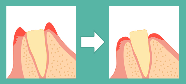 被せる歯質が少ない時には、クラウンレングスニング（歯冠長延長術）