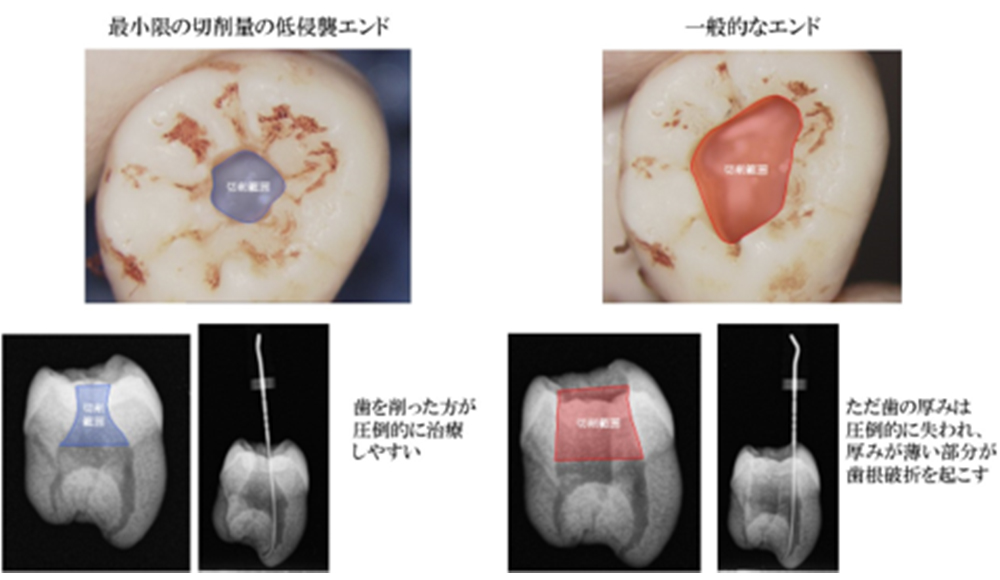 最小限の歯質の切削量