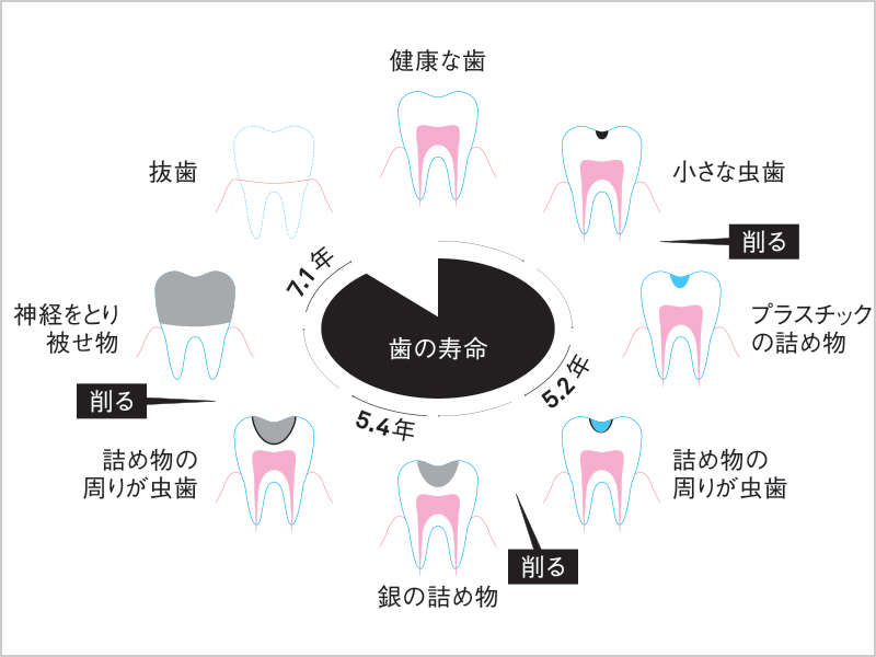 歯髄保存療法の適応が難しい方は、精密根管治療へ