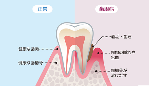 歯周病＝自覚症状がなくても、進行している病気