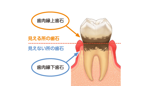 歯周病＝自覚症状がなくても、進行している病気